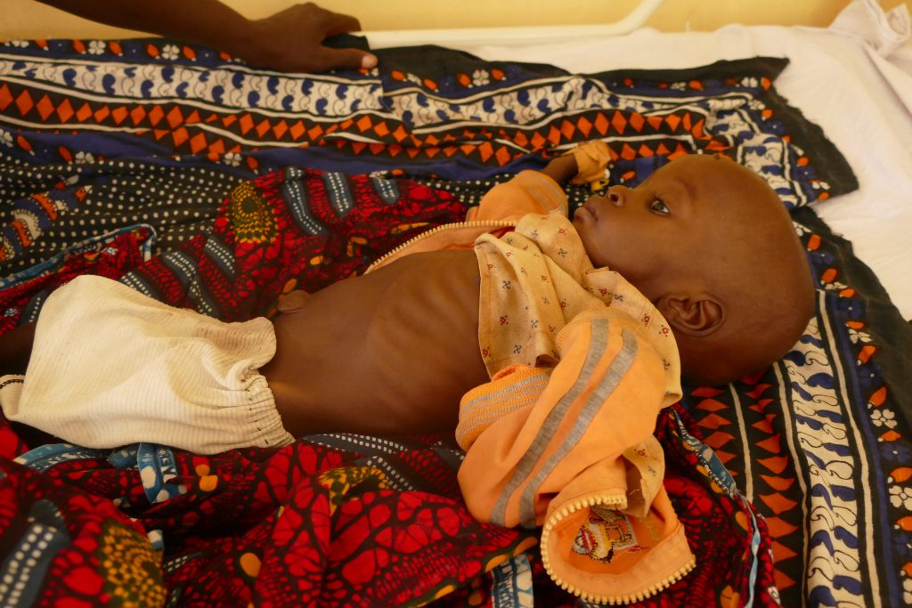 kindje met ondervoeding